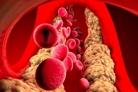 Czerwone krwinki przepływają przez zatłuszczone naczynie krwionośne, gdzie cholesterol HDL podwyższony tworzy złogi.