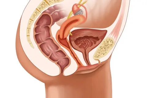 Illustration anatomique du pelvis féminin montrant le rectum, la vessie, l'utérus et les ligaments. Une condition comme le prolapsus vaginal peut affecter ces organes.