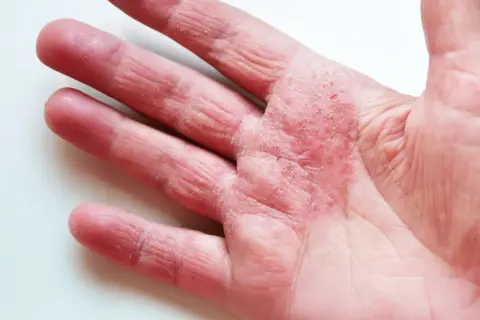 Rote, schuppige Haut an der Handfläche und den Fingern, Anzeichen von atopischem Ekzem. Gute Hautpflege ist wichtig.