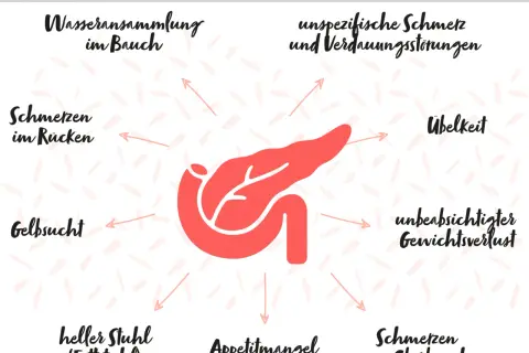Symptome bei Bauchspeicheldrüsenkrebs: Wasseransammlung im Bauch, Rückenschmerzen, Gelbsucht, heller Stuhl, Appetitmangel, Oberbauchschmerzen, Übelkeit, unbeabsichtigter Gewichtsverlust.