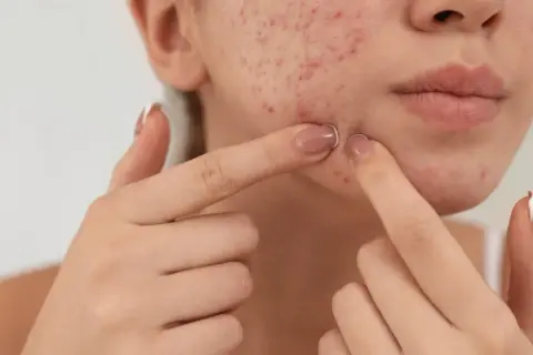 Haut mit Akne, die von Fingern berührt wird. Kollagen kann die wundheilung unterstützen.