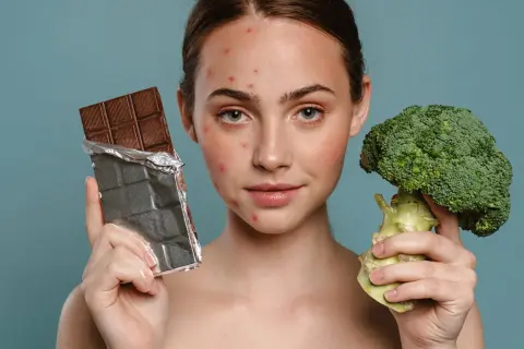Frau mit Pickeln hält Schokolade und Brokkoli. Welche Lebensmittel helfen gegen Pickel? Brokkoli ist gesund, Schokolade oft nicht.