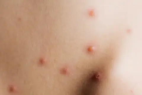 Piel con varias picaduras rojas e inflamadas, algunas con un punto central.