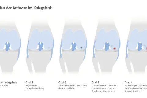 Illustrationen zeigen die Stadien der Arthrose im Kniegelenk, von gesundem Knorpel bis zum vollständigen Knorpeldefekt.