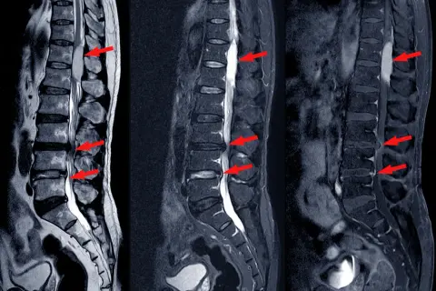MRI kręgosłupa lędźwiowego pokazuje przepuklinę dysku, która może powodować silny ból. Czerwone strzałki wskazują na ucisk na rdzeń kręgowy.