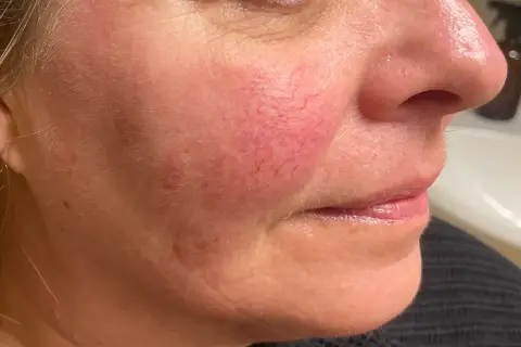 Närbild på en kvinnas kind med synliga blodkärl och rodnad. Finnar på kinderna kan vara ett tecken på rosacea.