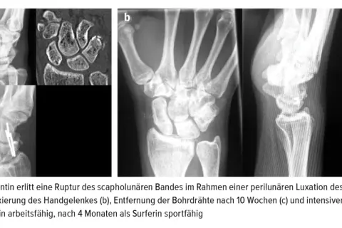 Röntgenbilder zeigen das distale Handgelenk vor und nach einer Operation.
Die Patientin ist nach 3 Monaten wieder arbeitsfähig.