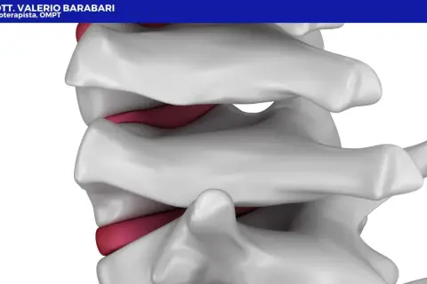 Dettaglio anatomico della colonna vertebrale, con dischi intervertebrali rossi tra le vertebre bianche. Illustra la potenziale area di interesse per la lordosi cura.
