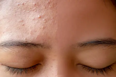 Gros plan sur le front d'une personne, montrant plusieurs petits boutons et une peau texturée. Les sourcils et les cils sont visibles.