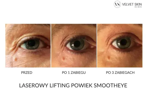 Przed i po zabiegach laserowego liftingu powiek. Efekty widoczne po 1 i 3 zabiegach. Laserowy lifting powiek ile się utrzymuje? Sprawdź efekty!