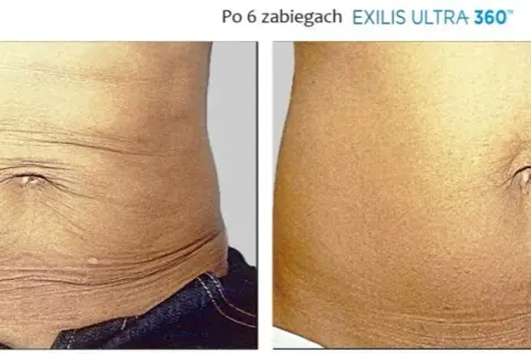 Jak pozbyć się brzucha po porodzie: 8 skutecznych metod
