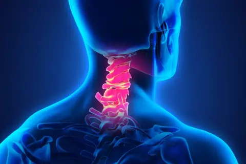 Colonna vertebrale cervicale illuminata in rosso, suggerendo cervicalgia e vertigini.