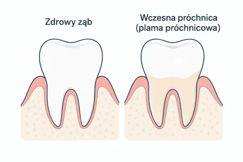 Zdrowy ząb obok zęba z wczesną próchnicą, która zaczyna tworzyć małą dziurę.