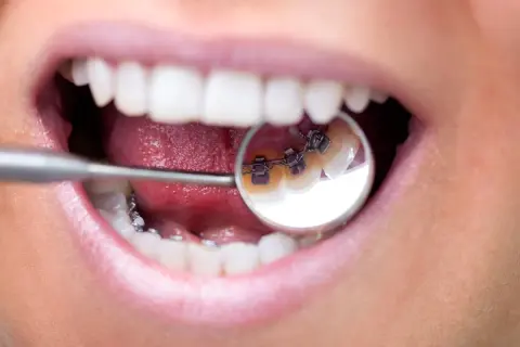 Primo piano di una bocca con apparecchio dentale. Il morso profondo apparecchio è visibile nello specchietto del dentista.