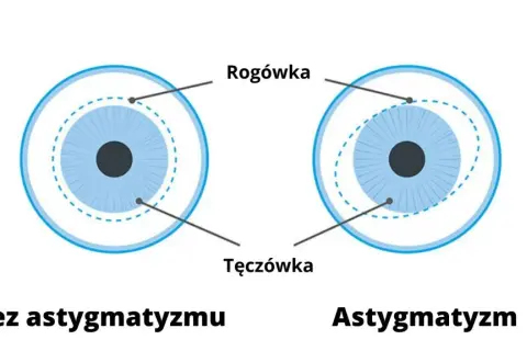 Astygmatyzm: Czy okulary są konieczne? Sprawdź, od czego zależy