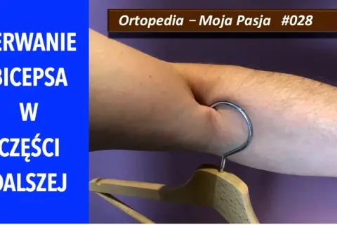 Zerwanie bicepsa w części dalszej. Ramię z wieszakiem, symbolizujące uraz. Ortopedia – Moja Pasja #028.