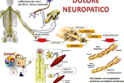 Il dolore neuropatico è illustrato con schemi di nervi, vasi sanguigni e muscoli, mostrando i danni da neuropatia diabetica.
