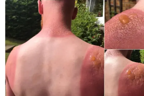Schwerer Sonnenbrand mit Blasenbildung an Schultern und Nacken. Die Frage "wie lange dauert ein sonnenbrand" wird hier schmerzhaft beantwortet.