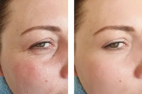 Comparaison avant/après : la peau ridée à gauche est lissée à droite, montrant l'efficacité du tretinoin vs retinol pour réduire les rides.