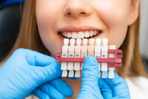 Uśmiechnięta kobieta z paletą odcieni zębów. Dentysta w niebieskich rękawiczkach dobiera kolor do wybielania zębów.