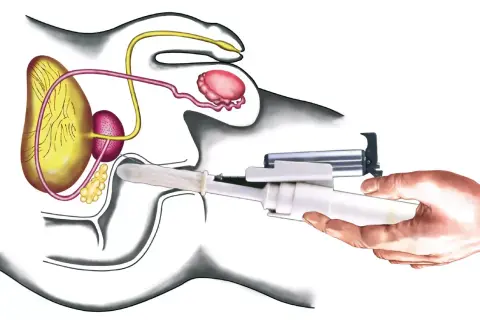 Darstellung der radikalen Prostatektomie: Ein chirurgisches Instrument wird eingeführt, um die Prostata zu entfernen.