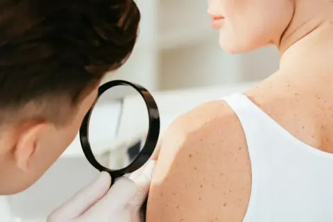 Dermatologia co to? Lekarz ogląda pieprzyki na ramieniu pacjentki przez lupę.