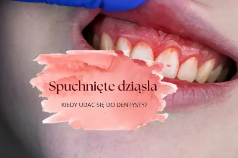 Spuchnięte dziąsło: Szybka ulga, przyczyny i kiedy do dentysty?