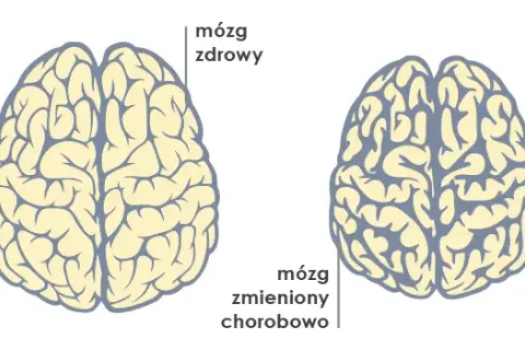 Demencja to nie choroba psychiczna? Poznaj kluczowe różnice