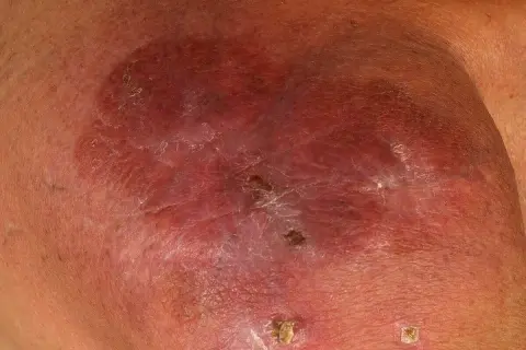 Hautläsionen, die auf multiples Myelom hindeuten. Rötliche, geschwollene Stelle mit schuppiger Oberfläche und kleinen Krusten.