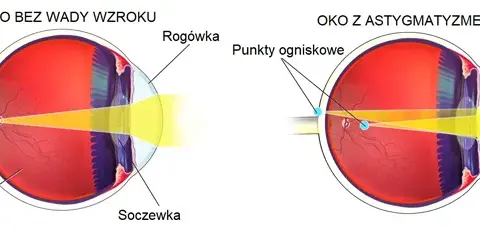 Astygmatyzm u dorosłych: Czy ustępuje? Poznaj metody korekcji