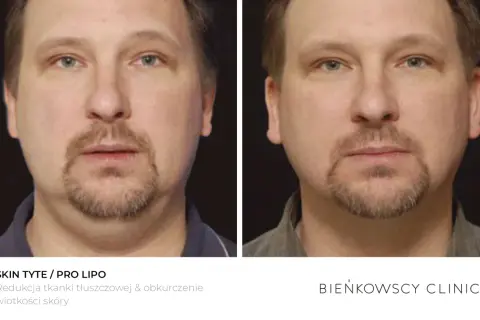 Przed i po zabiegu redukcji tkanki tłuszczowej. Widoczne lipoliza ud efekty, poprawa konturu twarzy i napięcie skóry.
