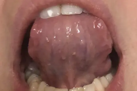 Lingua con piccole protuberanze, forse un papilloma sotto la lingua, visibile con i denti in primo piano.