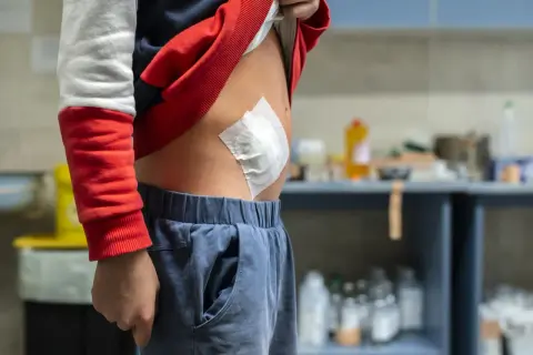 Dziecko z opatrunkiem na brzuchu po operacji.