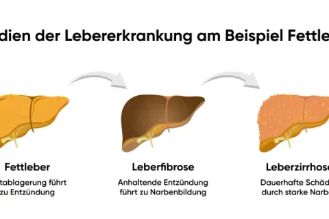 Verlauf einer Lebererkrankung: gesunde Leber, Fettleber, Leberfibrose, Leberzirrhose und Leberkrebs. Stres oksydacyjny kann diese Entwicklung beschleunigen.