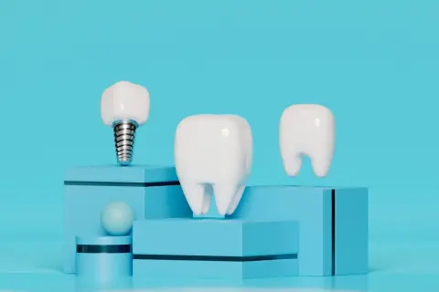 Un implante dental junto a dientes, sobre cubos azules.