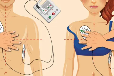 Ilustracja pokazuje, jak działa defibrylator: elektrody przyklejane są do klatki piersiowej, a urządzenie analizuje rytm serca.