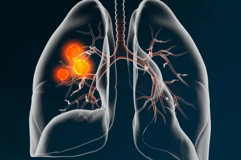 Darstellung von Lungenkrebs (NSCLC) mit leuchtend orangefarbenen Tumoren, die sich in den Bronchien ausbreiten. Medizinische Illustration.