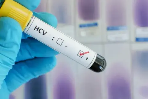 Ile kosztuje badanie HCV? Ceny, które mogą cię zaskoczyć
