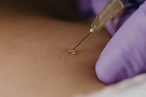 Gros plan sur une aiguille fine pour une infiltration du dos, une goutte de liquide prête à être injectée.