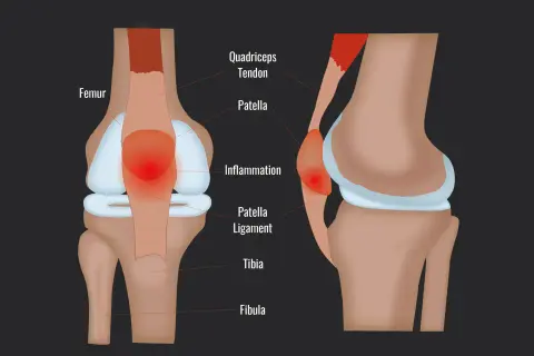 Entzündung der Patella Sehne am Kniegelenk, mit Femur, Patella und Tibia.