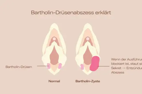 Vergleich von normaler Bartholin-Drüse und Bartholin-Zyste/Abszess im Intimbereich. Zeigt, wie Sekretstau zu Entzündung und Abszess führt.