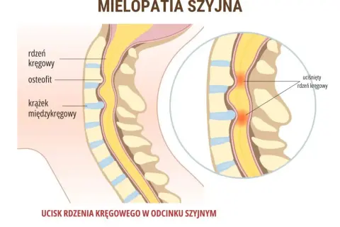 Ucisk na rdzeń kręgowy w odcinku szyjnym, prowadzący do mielopatii i potencjalnego drętwienia barku. Widoczne osteofity i krążki międzykręgowe.