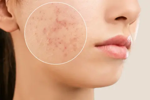 Gros plan sur une joue montrant des rougeurs et des imperfections, rappelant l'acné à 50 ans chez un homme.
