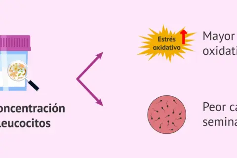 Recipiente con alta concentración de leucocitos, que indica mayor estrés oxidativo y peor calidad seminal.
