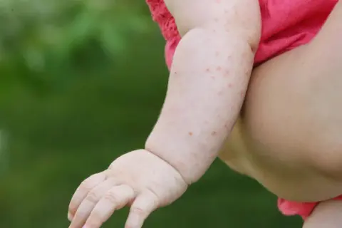 Rączka dziecka w różowej bluzeczce z czerwonymi kropkami, które mogą być objawem odry. Choroba ta wymaga konsultacji lekarskiej.