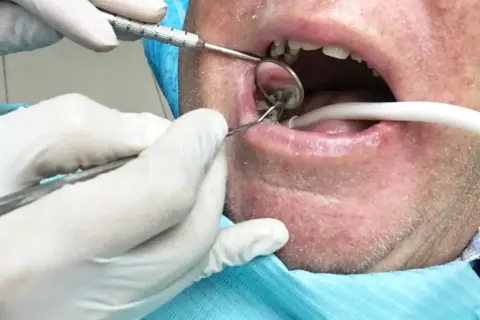 Dentysta usuwa korzeń zęba z ropą, używając lusterka i narzędzi.