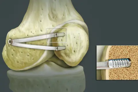 Knochen mit MPFL-Plastik-Implantat zur Stabilisierung der Kniescheibe. Detailansicht zeigt Schraube im Knochen.