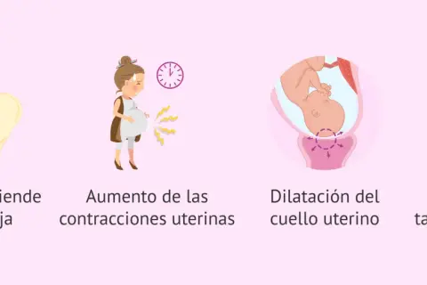 Ilustración de las etapas del parto normal: bebé encajado, contracciones, dilatación y rotura del tapón mucoso.