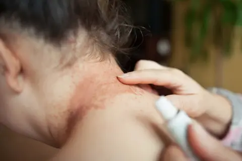 En person applicerar kräm på en röd, fläckig hud på nacken, troligen en allergisk reaktion.
