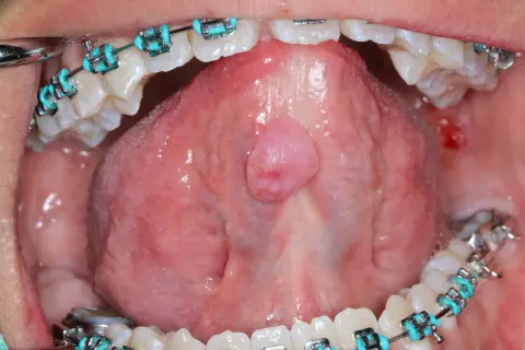 Lingua con apparecchio ortodontico e una piccola ranula, una lesione benigna.